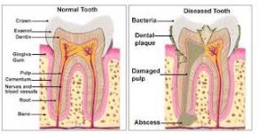 an image comparing a healthy tooth to a diseased tooth